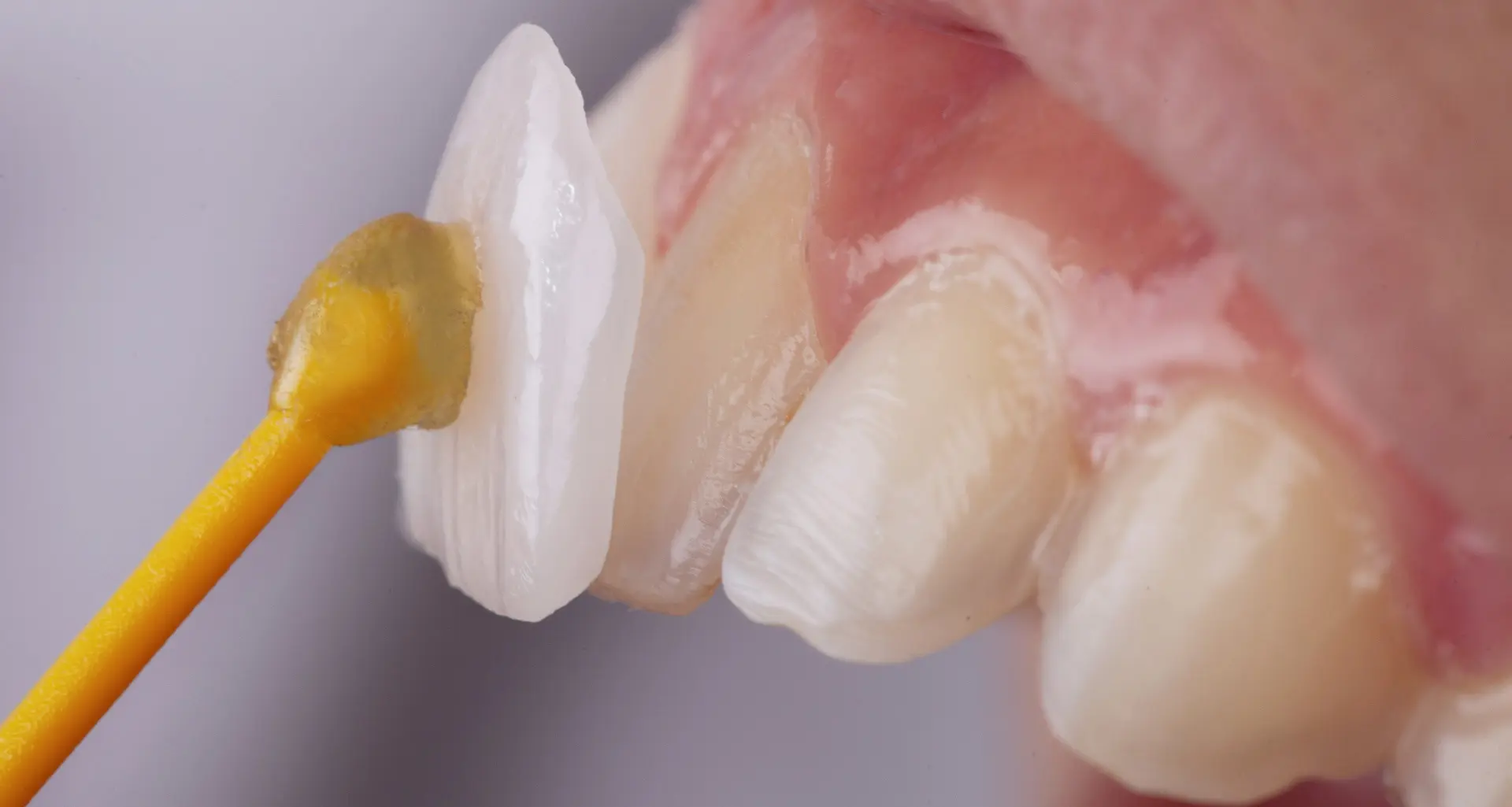 Odontoiatria protesica - Zubna protetika | Štimac centar dentalne medicine