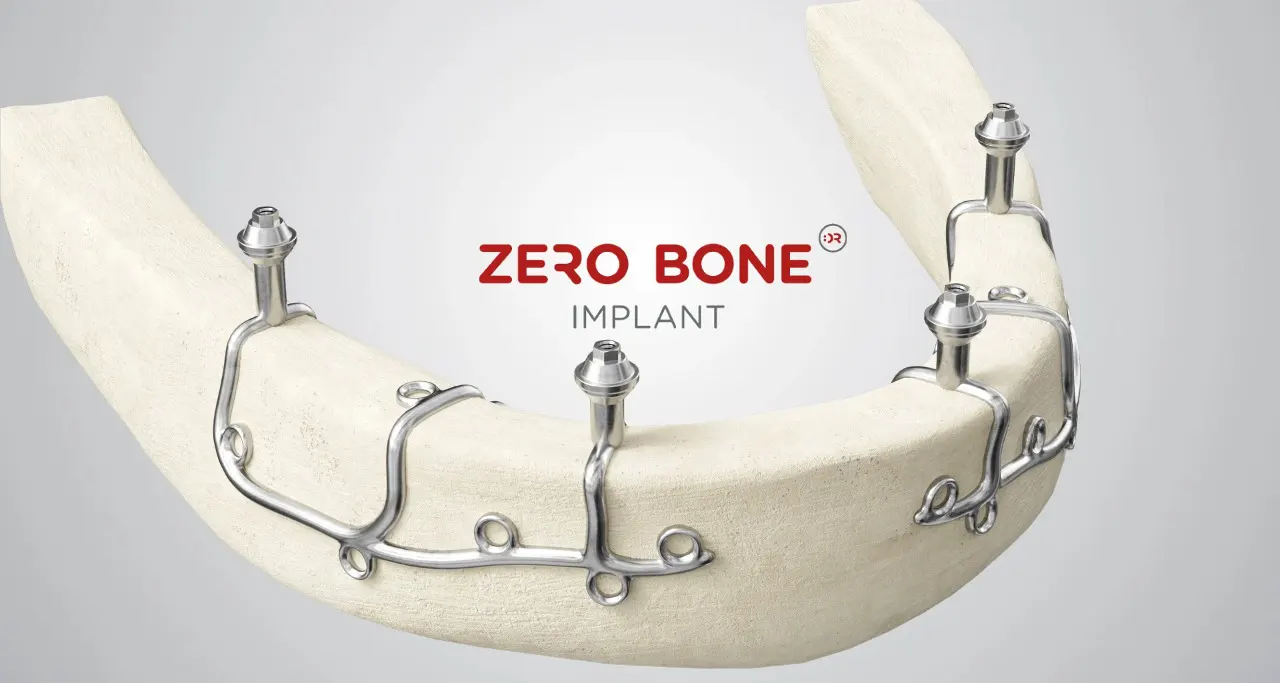 Impianti sottoperiostei - Zero Bone Implant Koncept | Štimac centar dentalne medicine