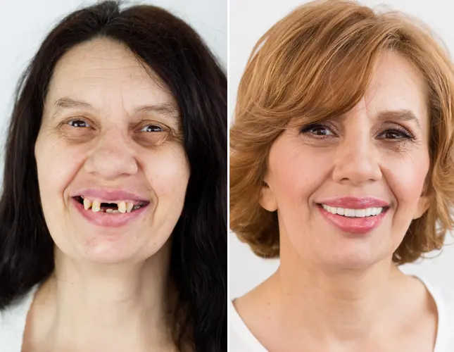 Impianti dentali | Rezultati implantati #1