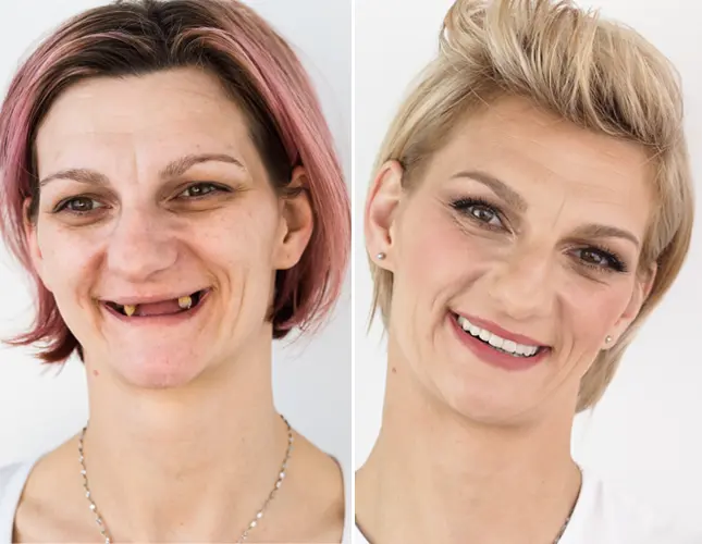 Impianti dentali | Rezultati implantati #2