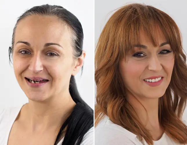 Ponti dentali Croazia | Zubni most | Cijena i ugradnja | Štimac centar dentalne medicine | Zubni mostovi | Stomatološka poliklinika Zagreb | Štimac centar dentalne medicine