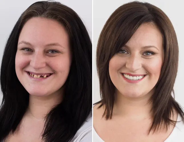 Ponti dentali Croazia | Zubni most | Cijena i ugradnja | Štimac centar dentalne medicine | Zubni mostovi | Stomatološka poliklinika Zagreb | Štimac centar dentalne medicine