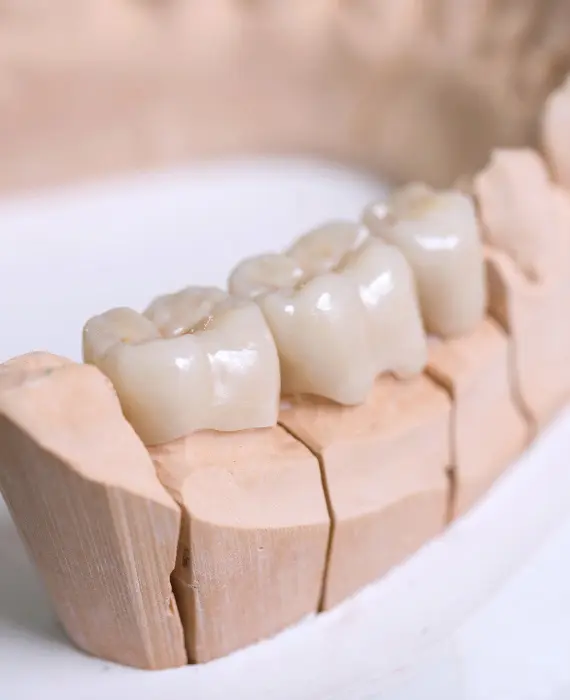 Odontoiatria protesica | KATERE SO CENE PROTETIČNIH NADOMESTKOV?