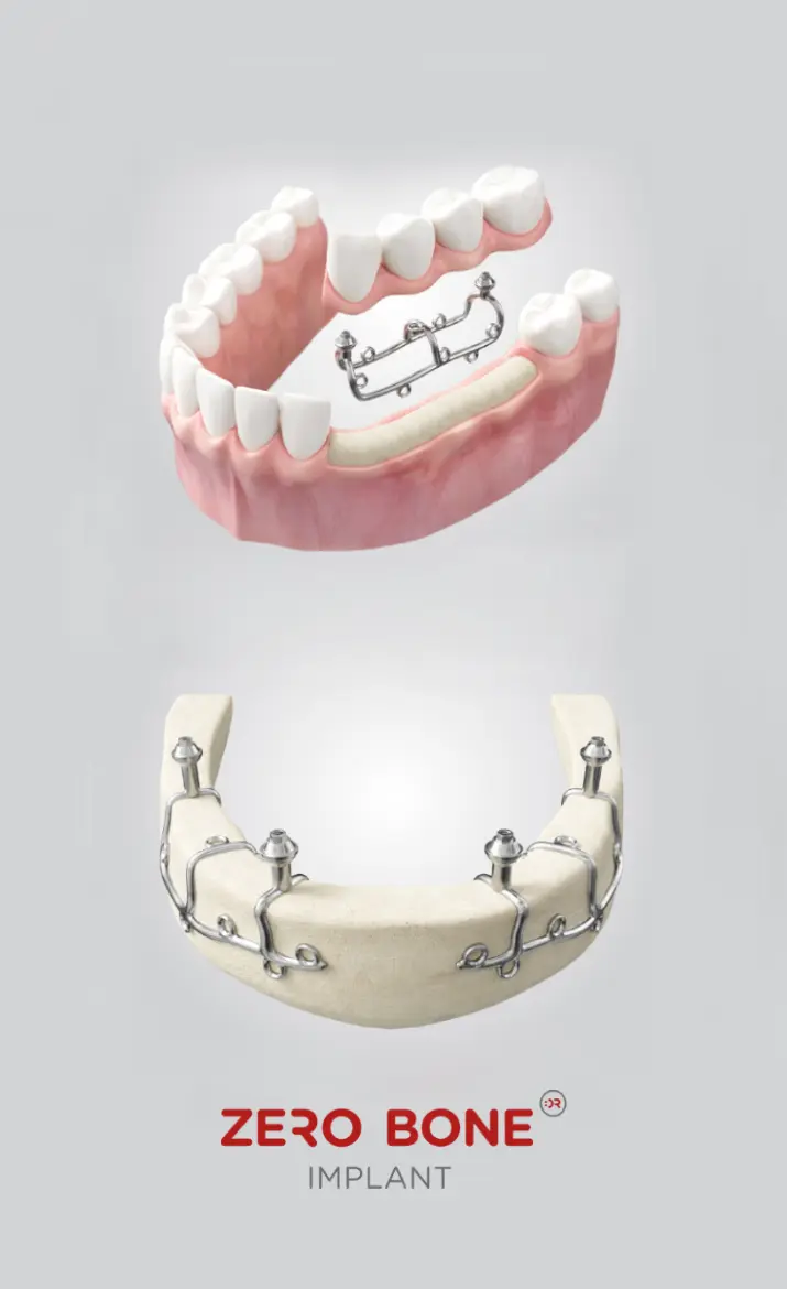 Impianti sottoperiostei | Subperiostalni implantati | Štimac Centar dentalne medicine | Subperiostalni implantati | Zero Bone Implant Koncept Štimac centar dentalne medicine