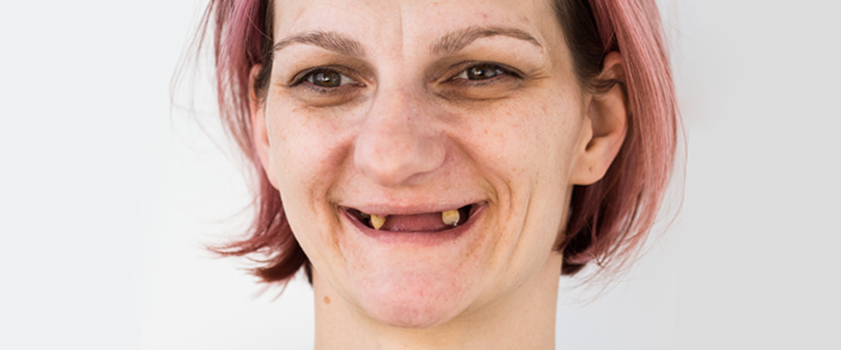 Makeover | Dental makeover | Slučaj ugradnje implantata, mostova i krunica