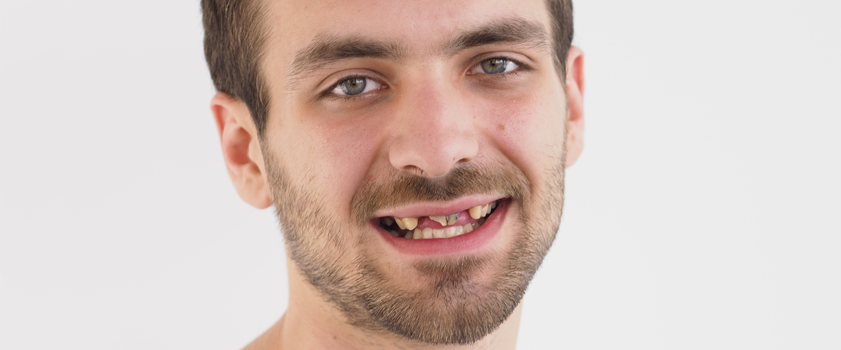 Makeover | Dental makeover | IMPLANTATI