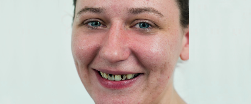 Makeover | Dental makeover | IZBJELJIVANJE ZUBI