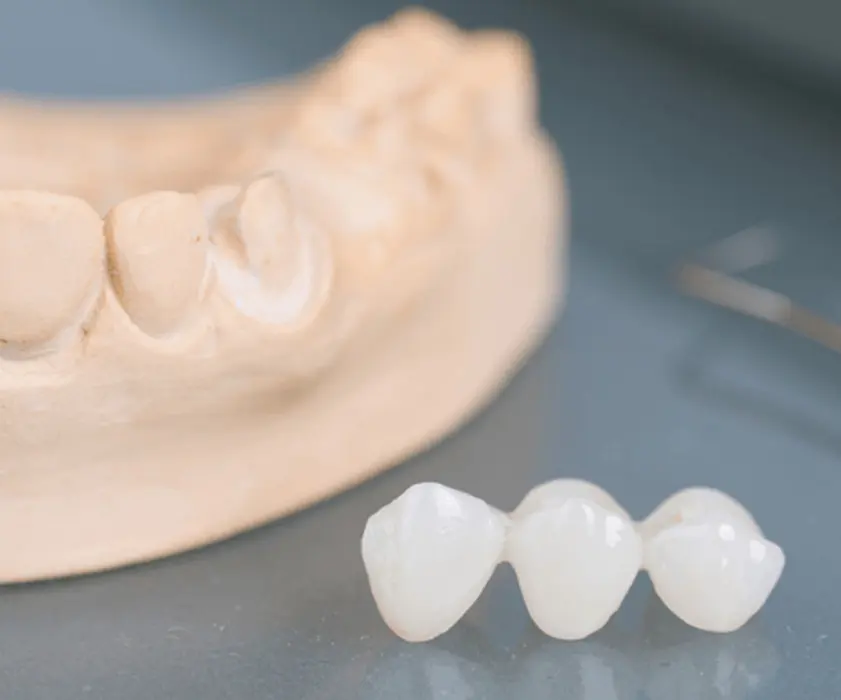 Odontoiatria protesica | ZUBNI MOSTOVI