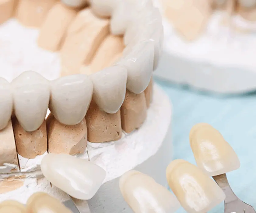 Ponti dentali Croazia | Zubni most | Cijena i ugradnja | Štimac centar dentalne medicine | Zubni mostovi | Stomatološka poliklinika Zagreb | Štimac centar dentalne medicine